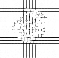 abnormal ansler grid